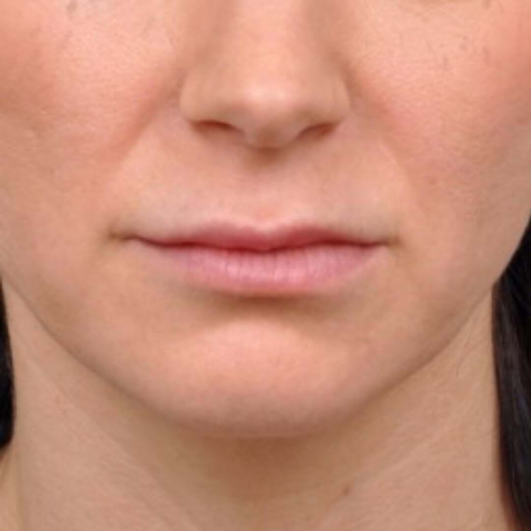 Close-up of lips before lip lift, showing subtle upper lip definition.
