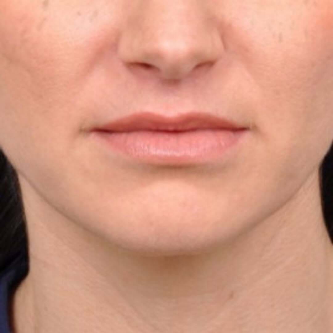Close-up of lips post-lip lift procedure, revealing enhanced upper lip volume and definition.