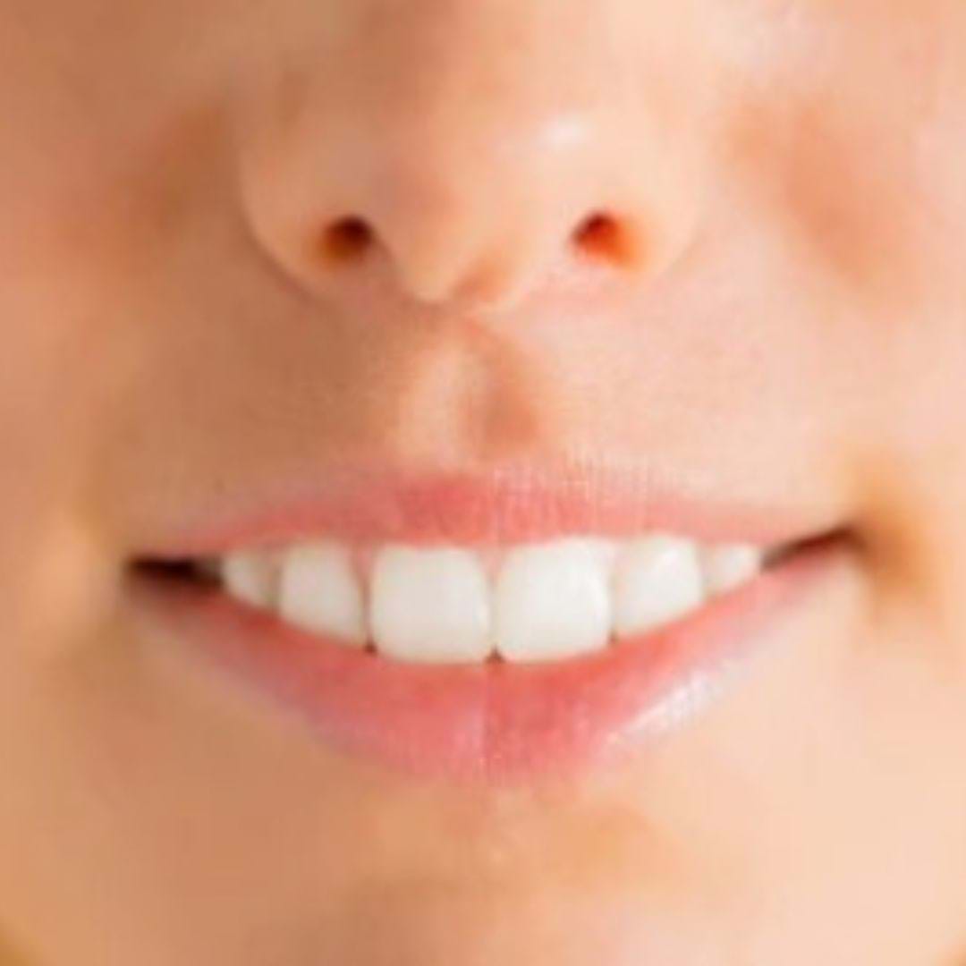 Frontal image of the face before lip lift 